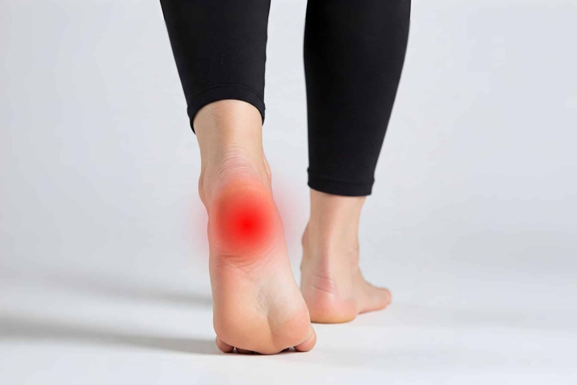 Heel pain in plantar fasciitis with red inflamed area highlighted